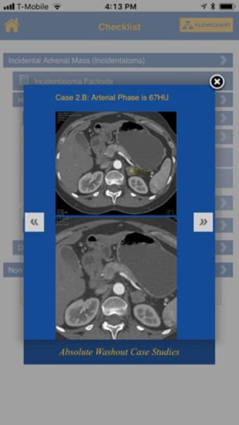 Image 3 for CTisus Adrenal Mass Check…