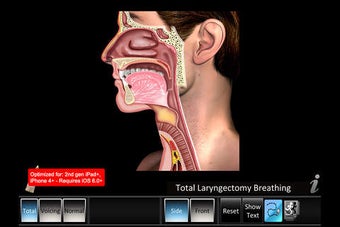 Image 0 for Laryngectomy