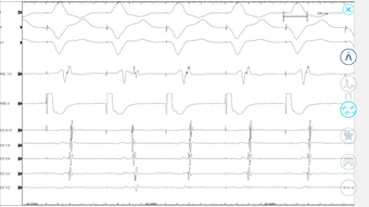 Image 0 for Cardiac Arrhythmia Challe…