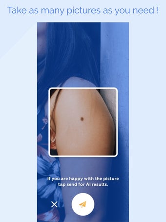 Image 1 for scanoma - mole check