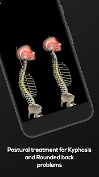Image 2 for Kyphosis & Rounded Back b…