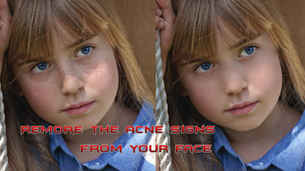 Image 1 for Pimples removing photo ed…