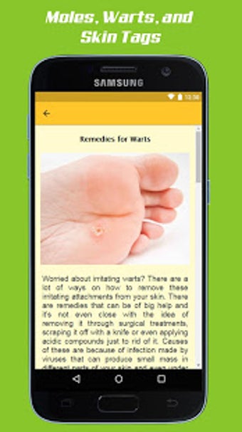 Image 3 for Mole Removal Remedies
