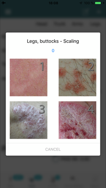 Image 0 for PsoriasisCalc