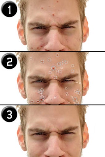 Imagen 0 para Pimple Eraser LITE