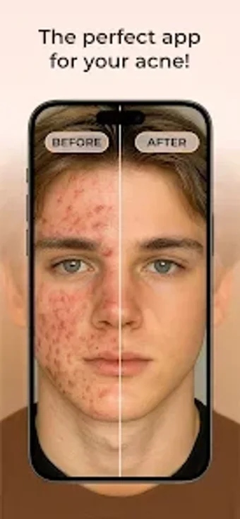 Imagen 0 para AcneTrack - Your Acne Jou…