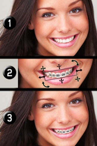 Image 0 for Brace Face