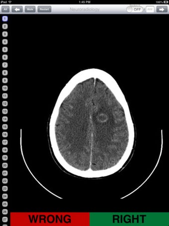 Image 2 for Neuroradiology Flashcards