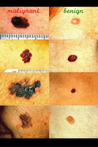 Image 0 for Melanoma Watch
