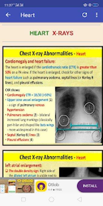 Image 2 for All Lung Sounds & Chest X…
