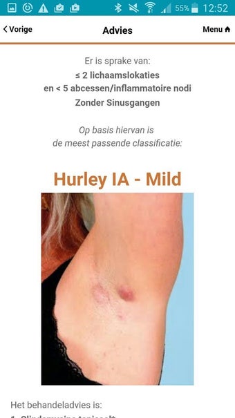 Imagen 2 para Hidradenitis Suppurativa …
