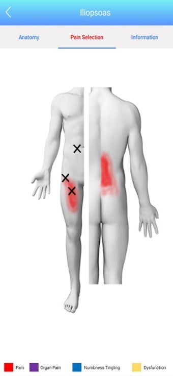 Image 3 for Referred Pain Index