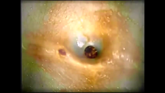 Image 2 for BLACKHEADS VIDEOS 2017