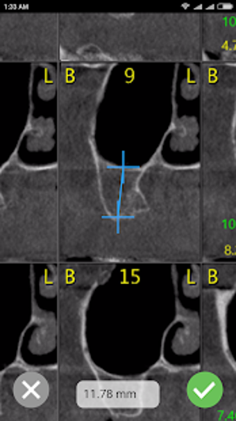 Image 0 for CBCT-Ruler