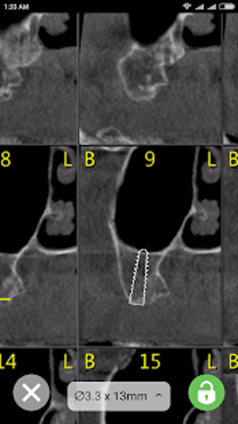Image 1 for CBCT-Ruler