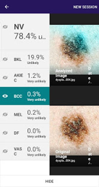 Image 1 for Visus: Skin Cancer Detect…