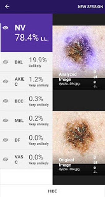 Image 3 for Visus: Skin Cancer Detect…