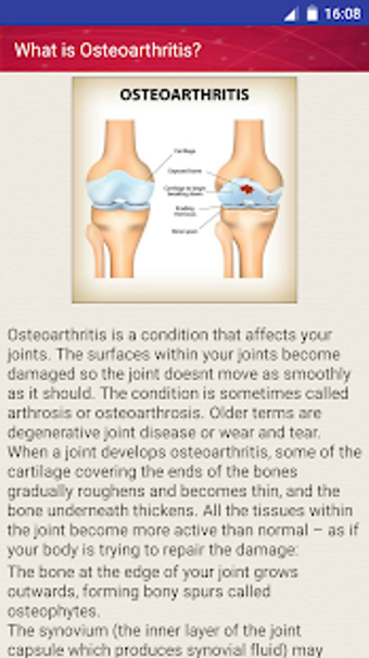 Image 3 for Osteoarthritis Joint Pain…
