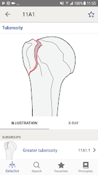 Image 0 for AO/OTA Fracture Classific…
