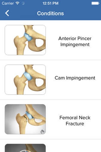 Imagen 0 para Hip Decide - Patient Enga…