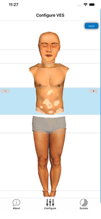 Image 1 for Vitiligo Calculator