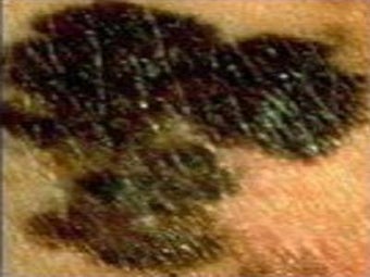 Imagen 0 para Skin Cancer Image Viewer
