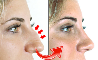 Image 1 for Nose Job Photo Editor