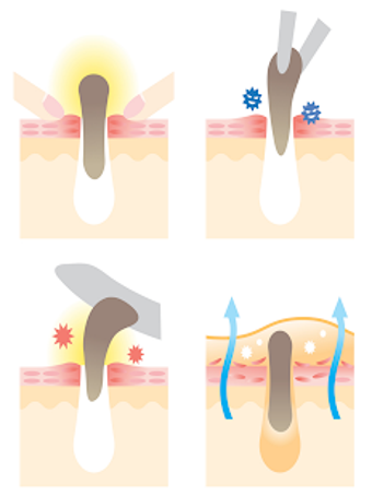 Imagen 0 para Remove Blackheads Videos