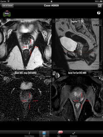 Image 2 for Prostate Cancer Imaging L…
