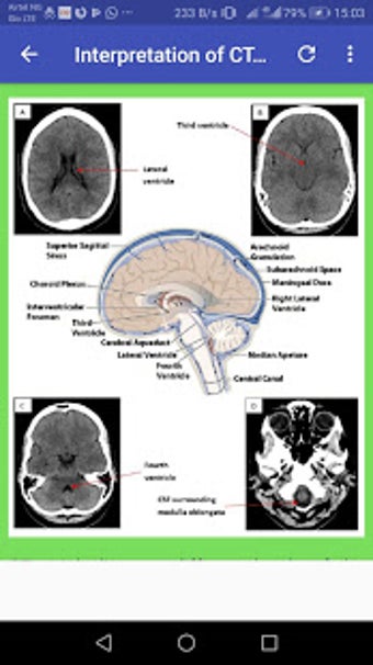 Image 2 for CT Brain Basic Interpreta…
