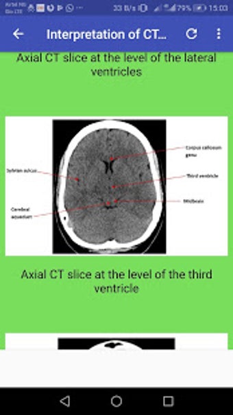 Image 0 for CT Brain Basic Interpreta…