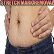 Icon of program: Natural Stretch Marks Rem…