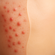 Icono de programa: AcneTrack - Your Acne Jou…