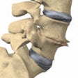 Icon of program: mLumbarDegenerativeDiscDi…