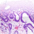 Icon of program: Cancer Staging
