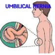 Icon of program: Umbilical Hernia Disease