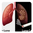 Icon of program: Lung cancer guide