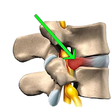 Icon of program: Herniated Disc Exercises