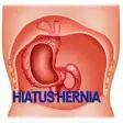 Icon of program: Hiatus Hernia Disease