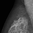 Icon of program: Mammography Localizer
